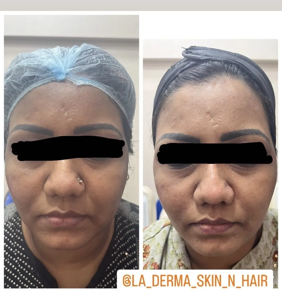 Under Eye and Mid Face Fillers