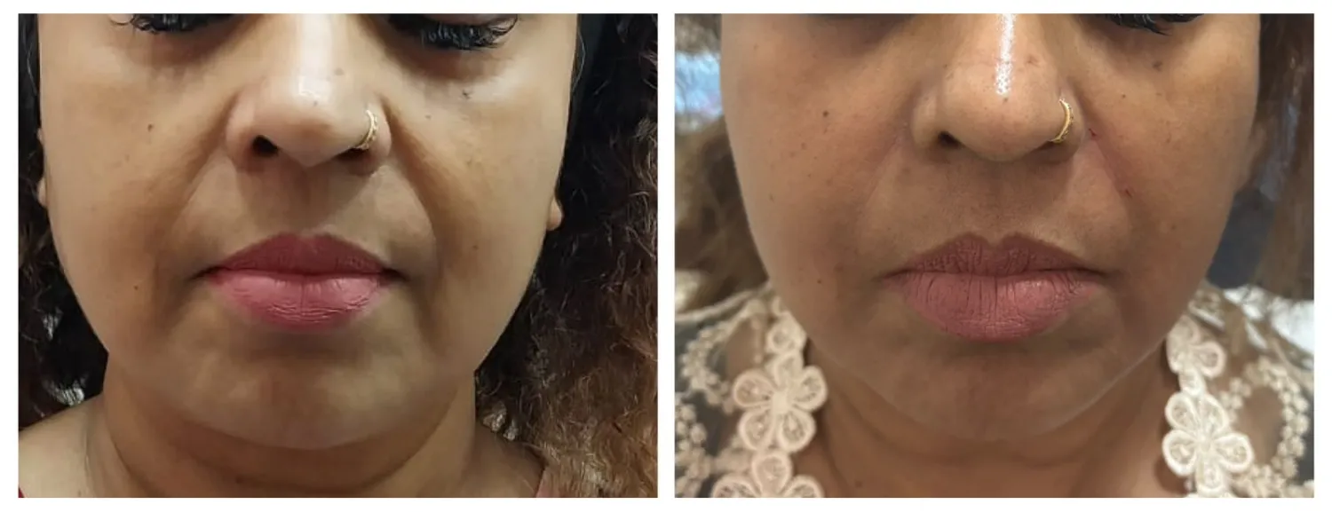 Mid Face Lift with Threads and fillers