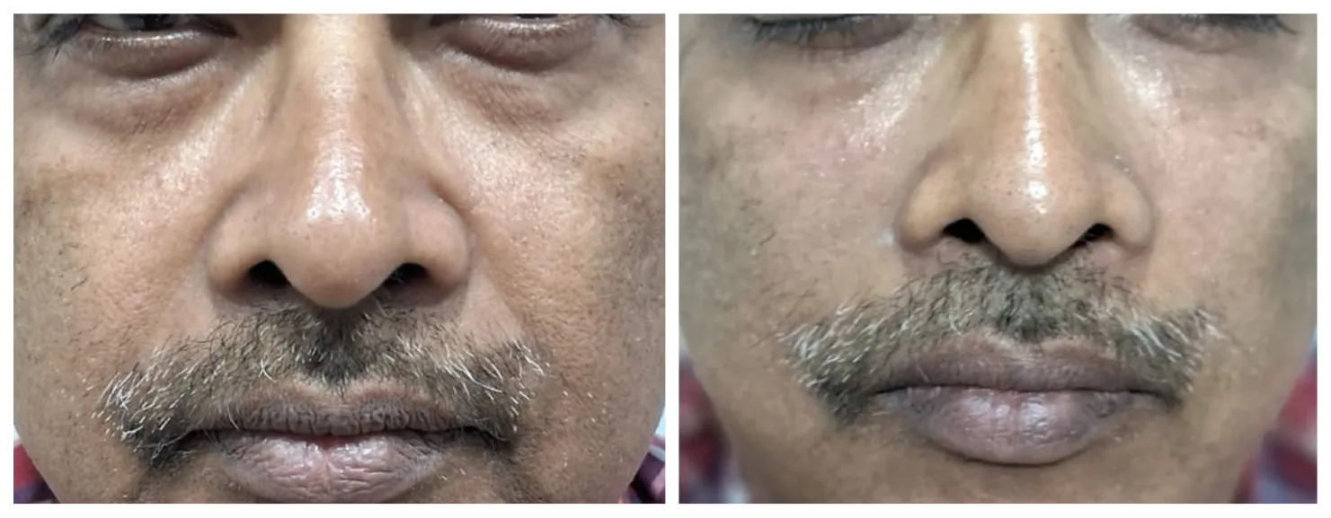 Under Eye and Mid Face Fillers